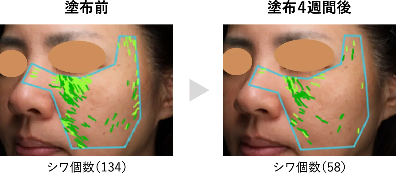 VISIAによる皮膚状態の解析（シワ改善例）-1