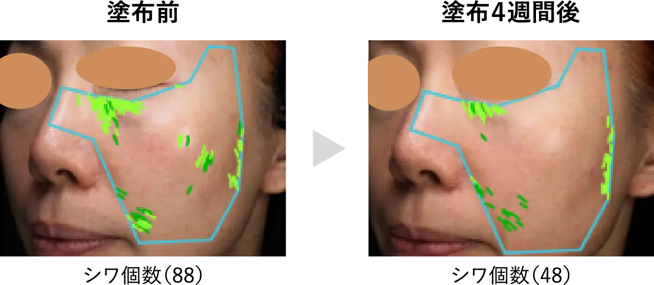 VISIAによる皮膚状態の解析（シワ改善例）-2