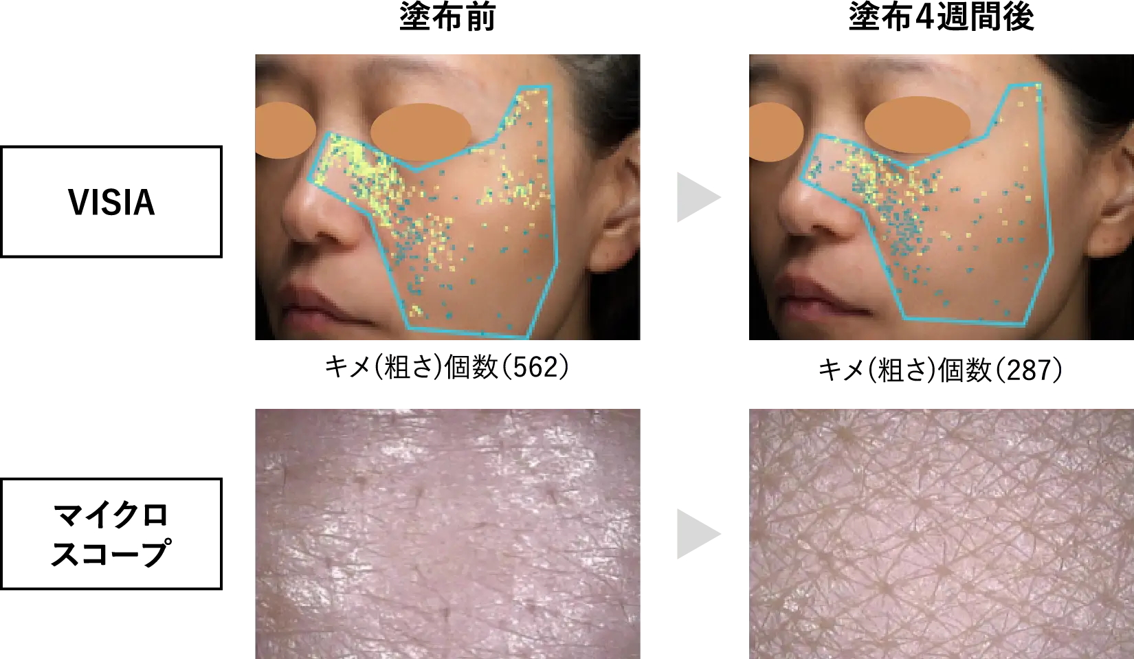 VISIAとマイクロスコープによる皮膚状態の解析（キメ（粗さ）改善例）-1