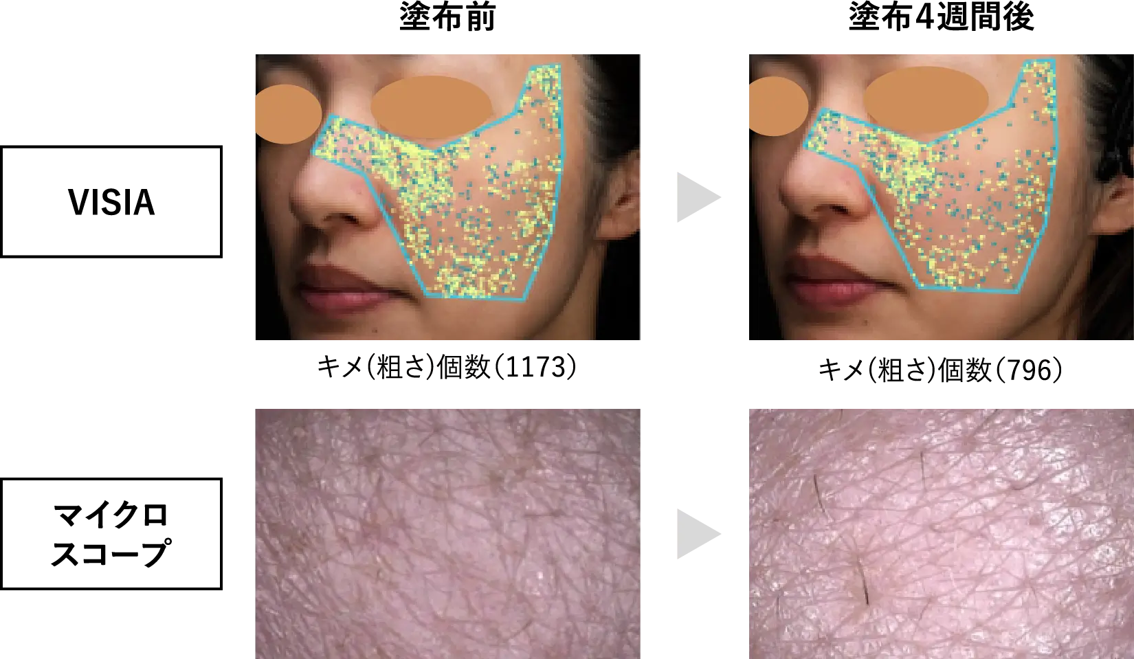 VISIAとマイクロスコープによる皮膚状態の解析（キメ（粗さ）改善例）-2