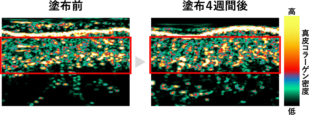 DermaLabによる真皮コラーゲン密度の解析（改善例）